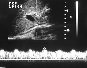 hepatic artery doppler after